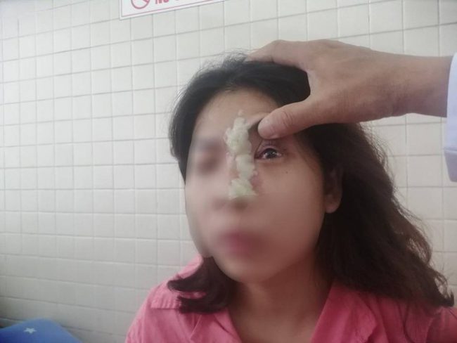 Một cô gái mù mắt sau khi tiêm filler nâng mũi tại spa. Ảnh: HL/Pháp Luật TP.HCM.