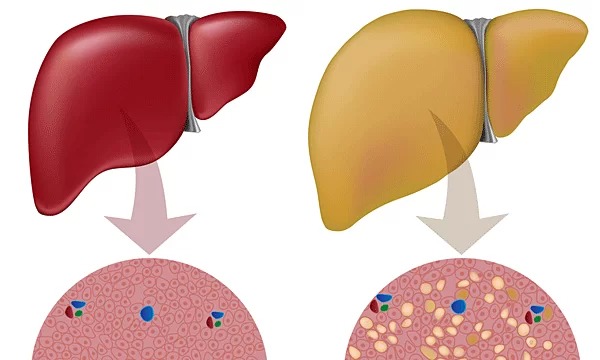 Mô phỏng gan khỏe mạnh (trái) và gan nhiễm mỡ (phải). Ảnh: Healthline.