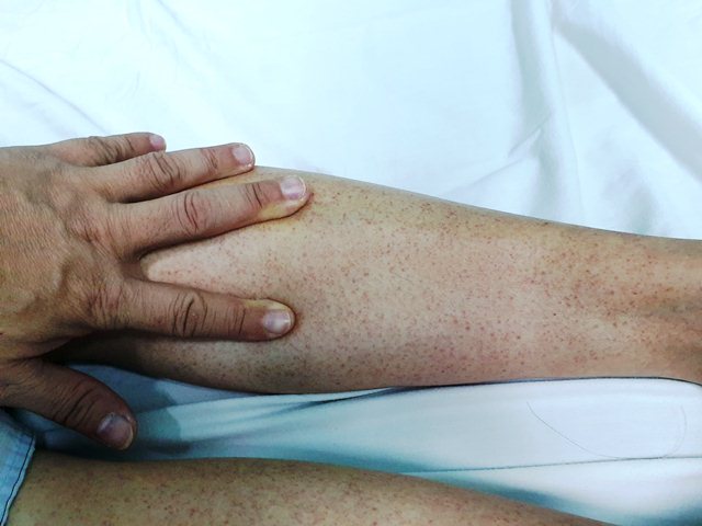 Một trường hợp điển hình của bệnh SXH với dấu hiệu xuất huyết dưới da ở cẳng chân.