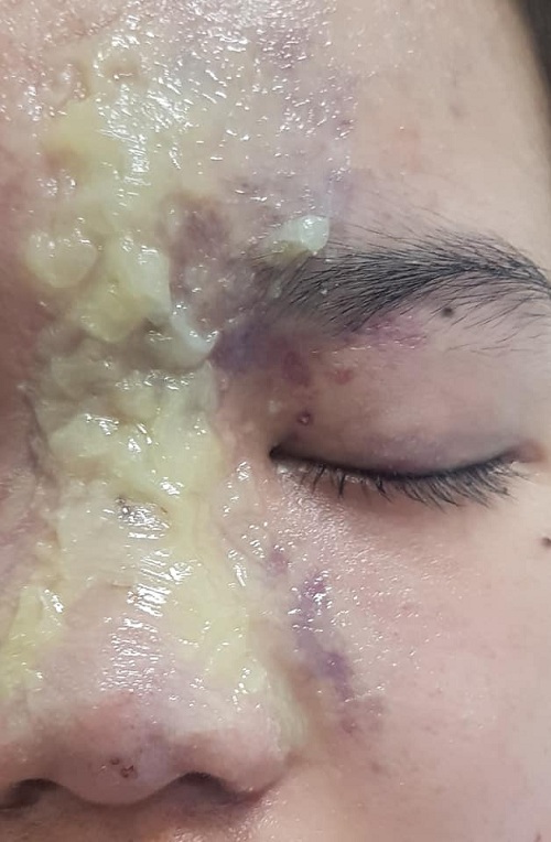 Biến chứng sau khi tiêm filler để nâng mũi. Ảnh BSCC