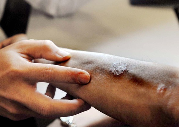 nhieu-benh-ve-da-bung-phat-tro-nang-khi-ret-dam